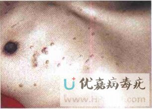 艾滋病伴發傳染性軟疣 1 例
