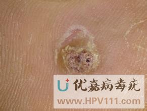 如何區(qū)別跖疣和雞眼