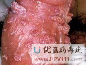 蘇州病毒疣醫(yī)院哪家好