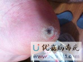 跖疣雞眼對(duì)比圖