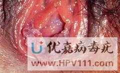 尖銳濕疣癥狀圖片