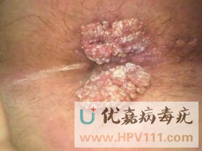 尖銳濕疣癥狀圖片