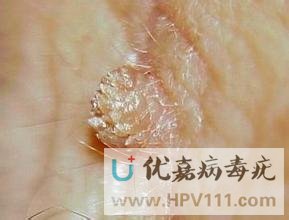 病毒疣圖片什么樣子