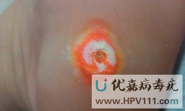 跖疣和雞眼的區別