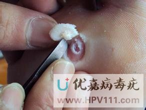 跖疣可以用雞眼膏嗎