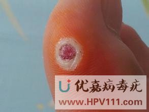 跖疣可以用雞眼膏嗎