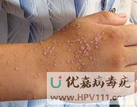 怎樣科學(xué)預(yù)防扁平疣