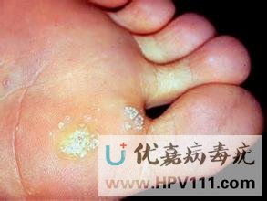 腳底病毒疣怎么引起的