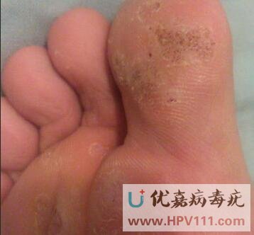 跖疣怎么樣才是好轉