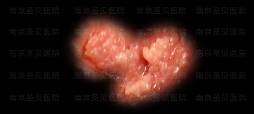 女性尖銳濕疣癥狀圖片