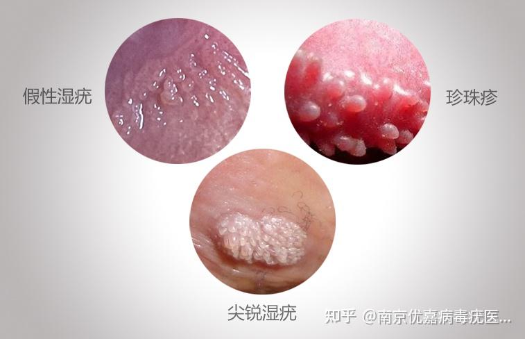 女性尖銳濕疣與假性區(qū)別圖片