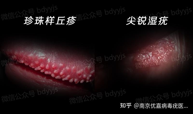 珍珠疹與尖銳濕疣圖片